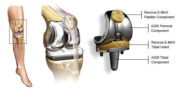 knee replacement, knee replacement surgery, knee replacement cost