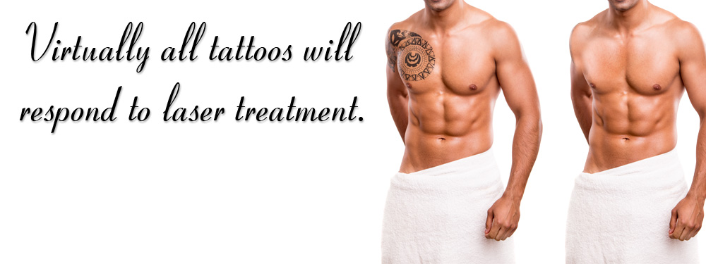 tattoo removal, laser tattoo removal