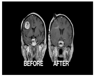 brain tumor treatment, brain tumor surgery