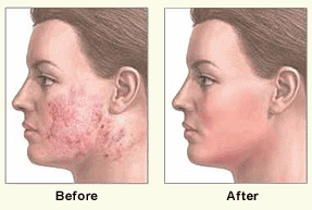 dermabrasion, dermabrasion for acne scars