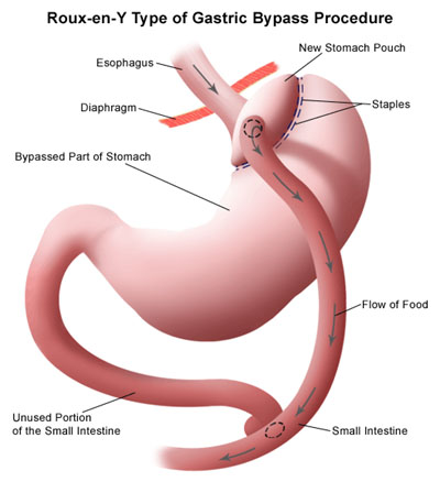 Rolux-En-Y Gastric Bypass Surgery, Gastric Bypass Procedure, Bariatric Surgery, weight loss surgery
