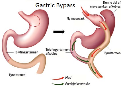Gastric bypass surgery, Rolux-En-Y Gastric Bypass Surgery, Bariatric Surgery, weight loss surgery