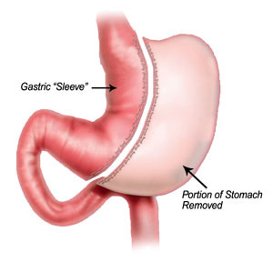 Gastric Sleeve, Sleeve gastrectomy, Gastric Sleeve Surgery, Sleeve gastrectomy