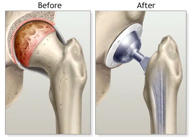 Total hip replacement, Total hip replacement surgery cost india, Total hip replacement surgery india