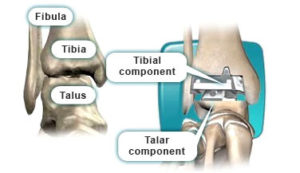 ankle joint replacement surgery