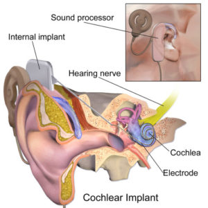 cochlear implant surgery, cochlear implant treatment