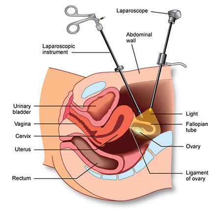 gynecologic laparoscopic surgery, procedure treatment