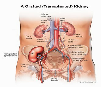 Kidney Transplant Treatment, Kidney Transplant Procedure, Surgery