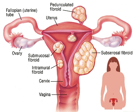 Uterus Removal, Hysterectomy, Uterus removal Surgery, Uterus Removal cost, Uterus Removal India