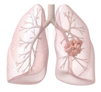 lung cancer, lung cancer surgery
