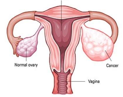 Ovarian Cancer, surgery, Treatment
