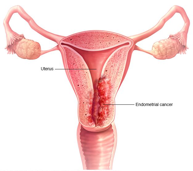 uterus cancer, surgery, treatment