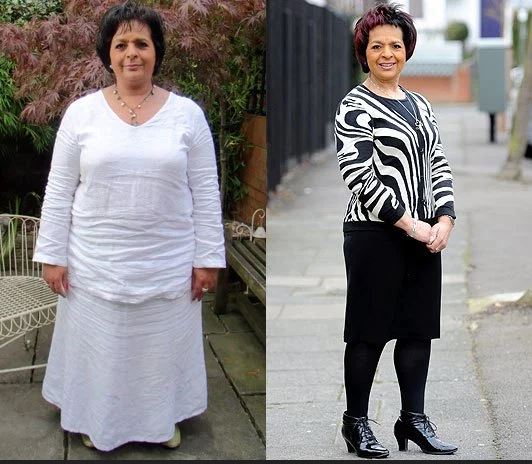 gastric-band-before-after